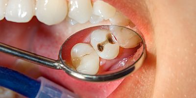 Dünyanın üçte birinden fazlası diş çürüğüyle yaşıyor!