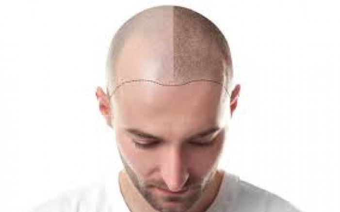 SAÇ EKİMİ ÇİÇEK EKMEYE BENZEMEZ