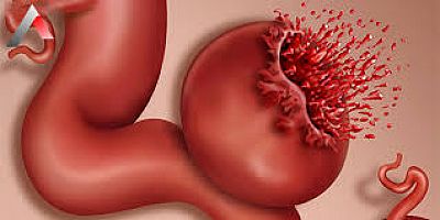 AORT ANEVRİZMASI SESSİZ VE DERİNDEN İLERLER