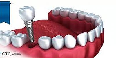 İMPLANT ŞAKAYA GELECEK BİR İŞLEM DEĞİLDİR!!!