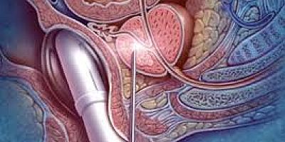 PROSTAT KANSERİ FARKINDALIK GÜNÜNÜ UNUTMAYALIM