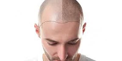 SAÇ EKİMİ ÇİÇEK EKMEYE BENZEMEZ