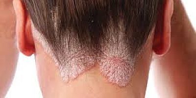 SEDEF HASTALIĞINA DOĞAL YAKLAŞIM